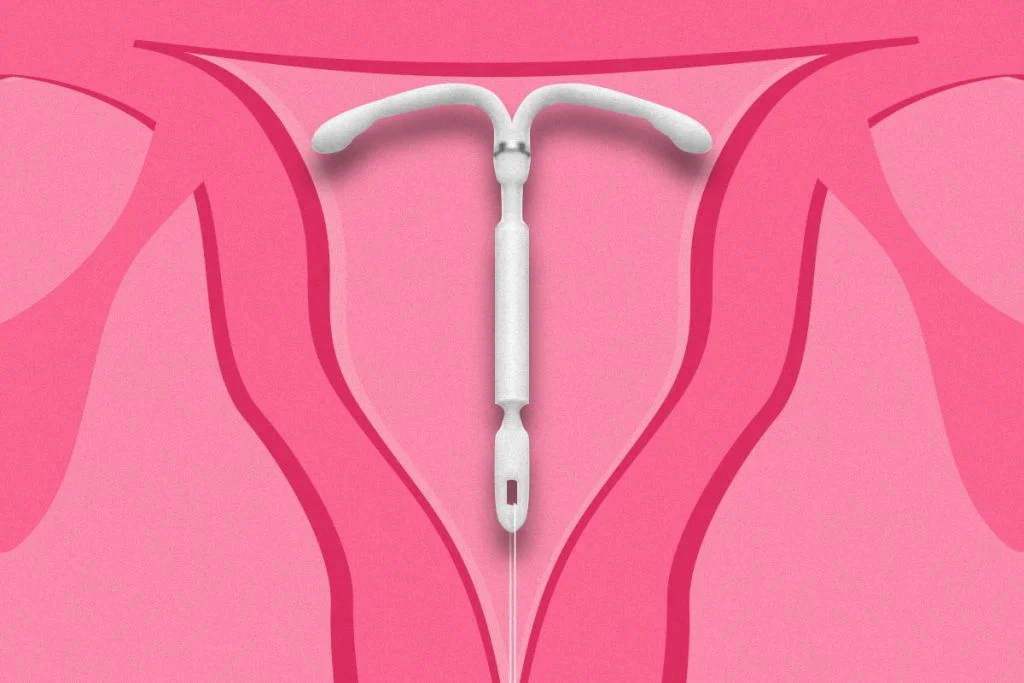Câncer de mama e o sistema intrauterino de levonorgestrel