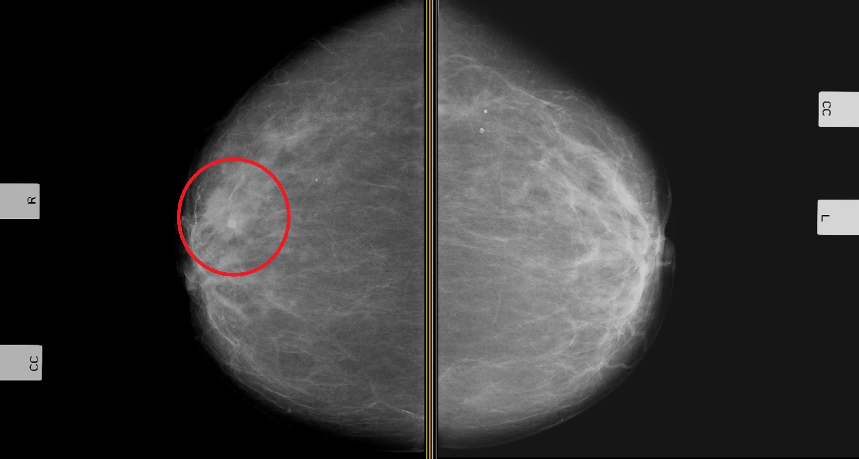 Mastectomia Bilateral e Mortalidade por Câncer de Mama